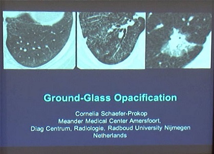 Ground-Glass Opacification