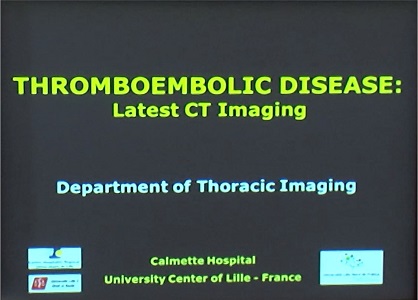 Thromboembolic Disease: Latest CT Imaging