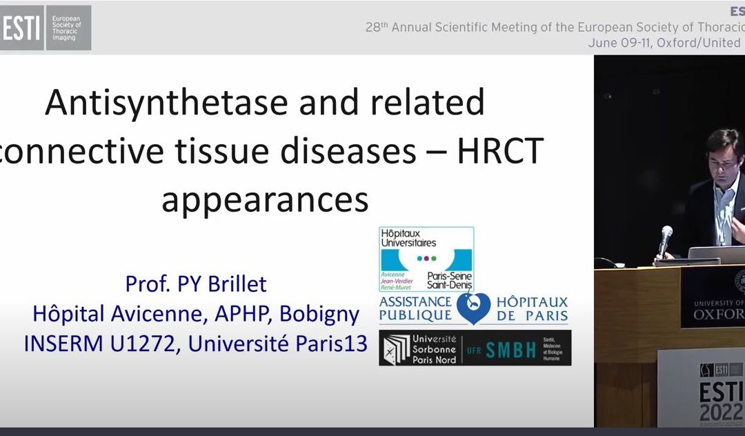 Antisynthetase and related connective tissue diseases – HRCT appearances